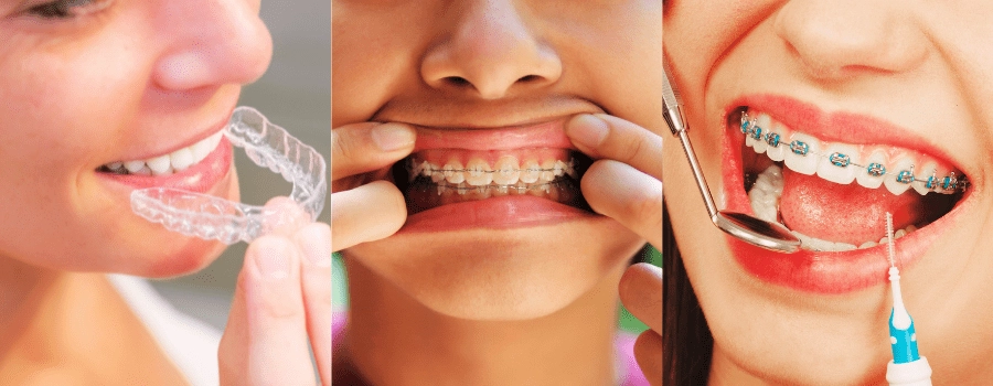 different types of braces